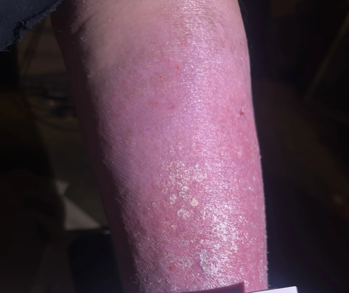 Healed venous wound